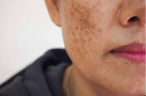 Dark spots freckles dry skin on face middle age woman .
