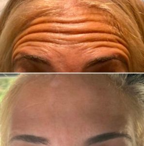 Before and After Forehead Pic Of BOTOX Cosmetic Treatment
