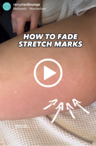 How to fade stretch marks