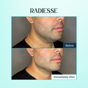 Radiesse Jawline Before and After