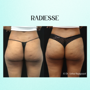 Radiesse Hip Dips Before and After