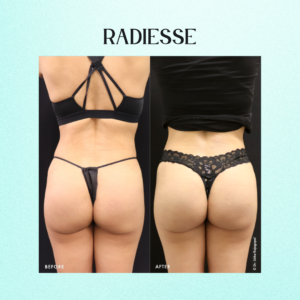 Radiesse Non-Surgical Butt Lift Before and After