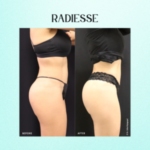 Radiesse Butt Before and After