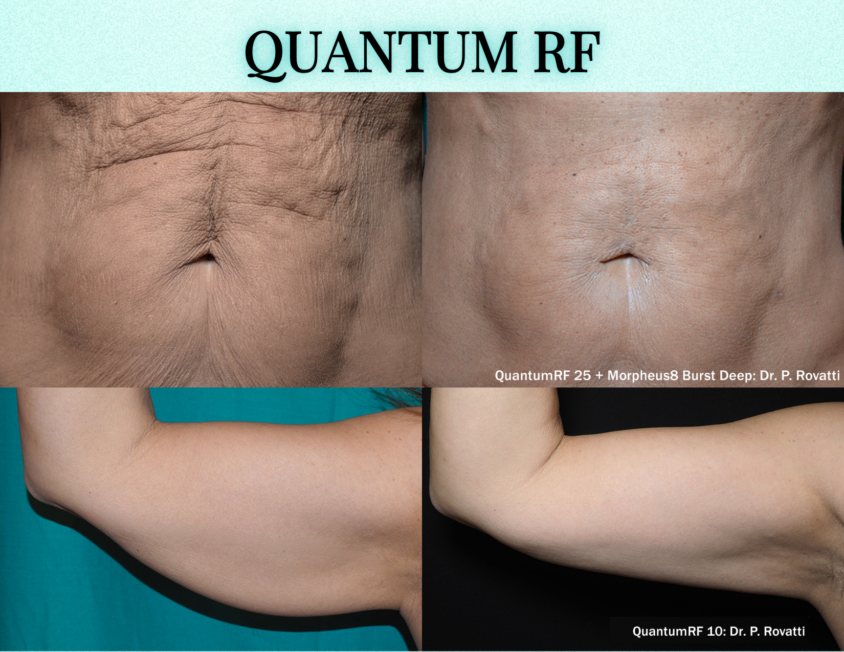 Unlock the Power of Quantum RF: Revolutionary Skin Tightening & Contouring at ReNu Med Lounge - ReNu Med Lounge Corp. Unlock the Power of Quantum RF: Revolutionary Skin Tightening & Contouring at ReNu Med Lounge - ReNu Med Lounge Corp.