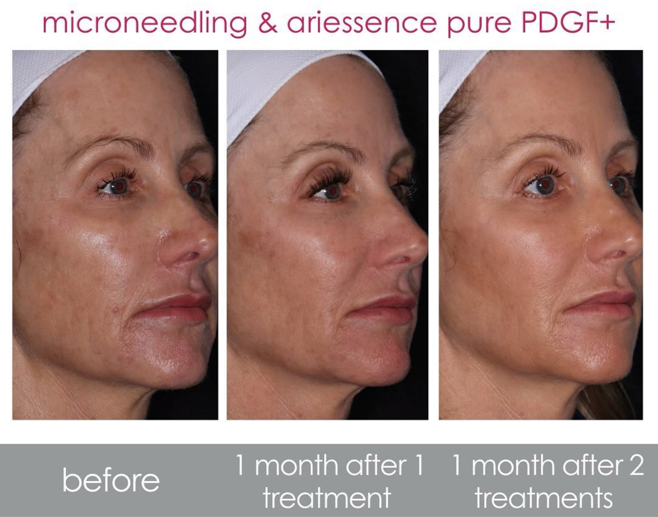 Discover Why We Can’t Get Enough of Ariessence pure PDGF+ - ReNu Med ...