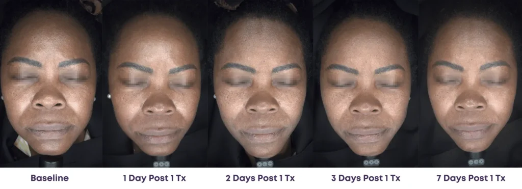 Pixel Peel CO2 Laser Los Angeles - Progression photo