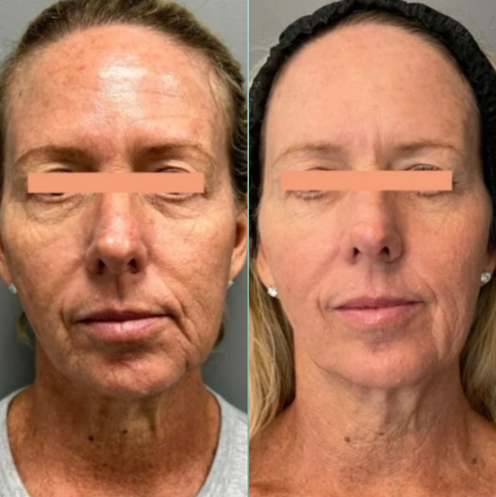 Everesse Everesse skin tightening Los Angeles