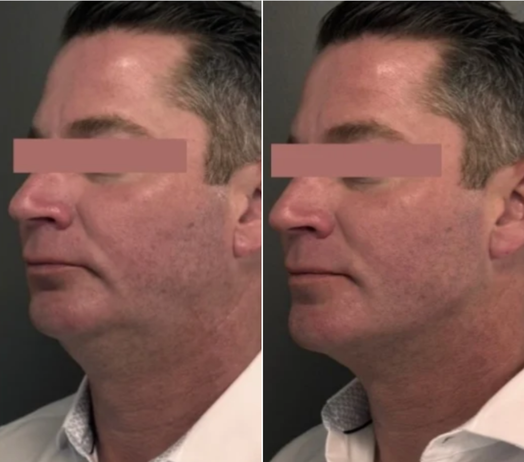 Everesse skin tightening for men