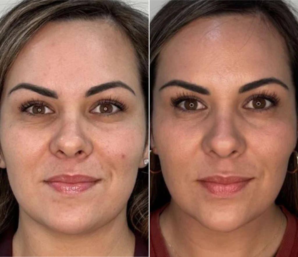 Everesse skin tightening