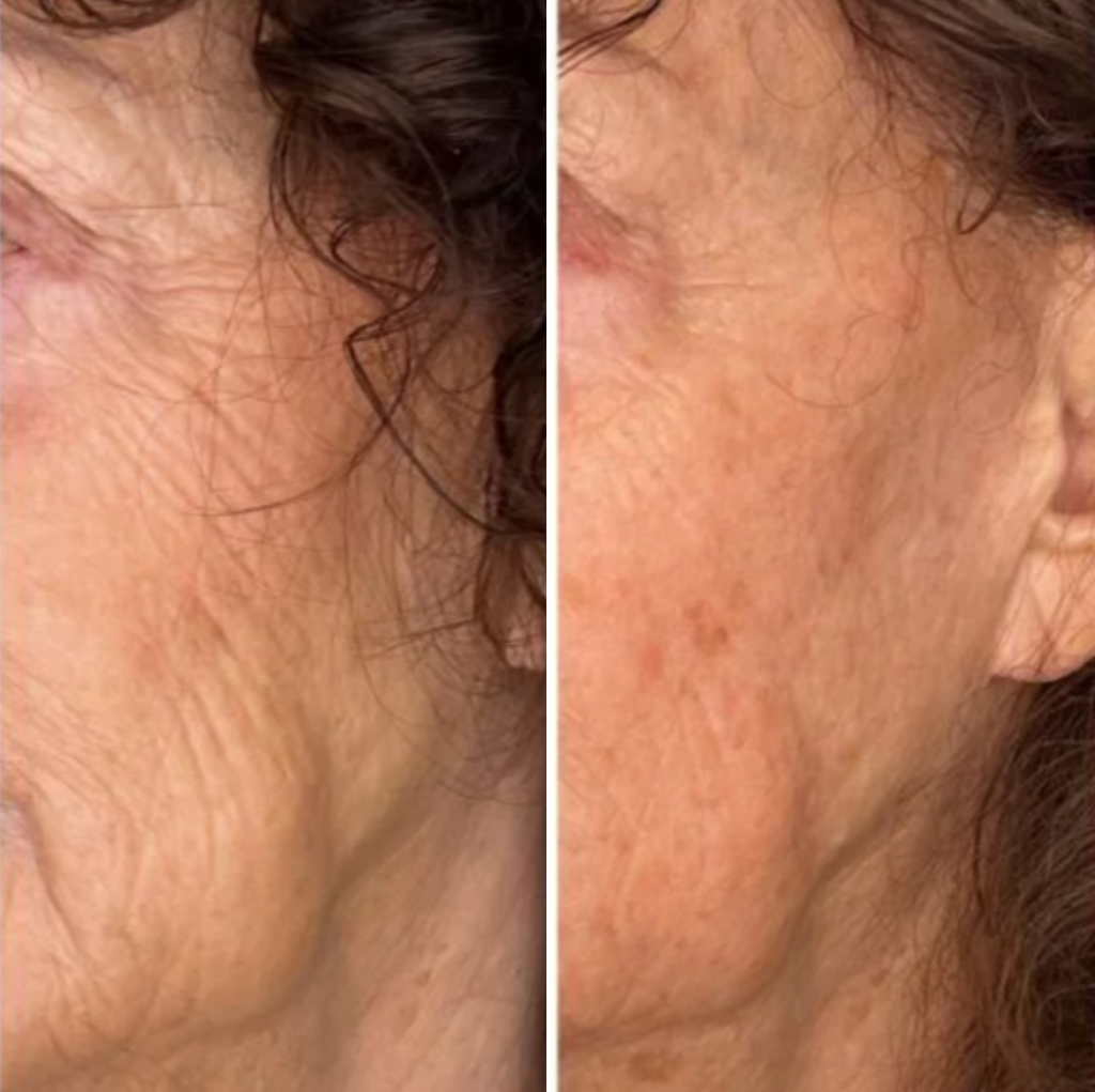 Everesse (9) Everesse skin tightening