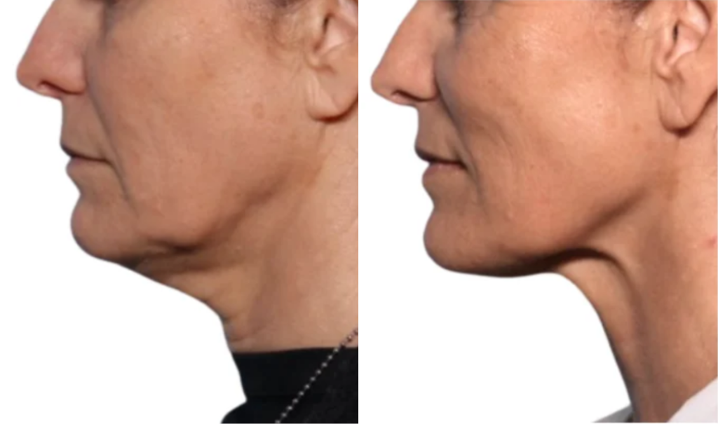 Onda (2) Onda double chin