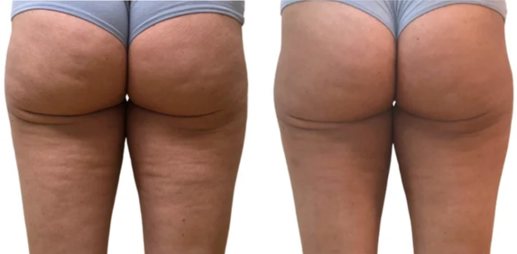 Onda (3) Onda cellulite removal