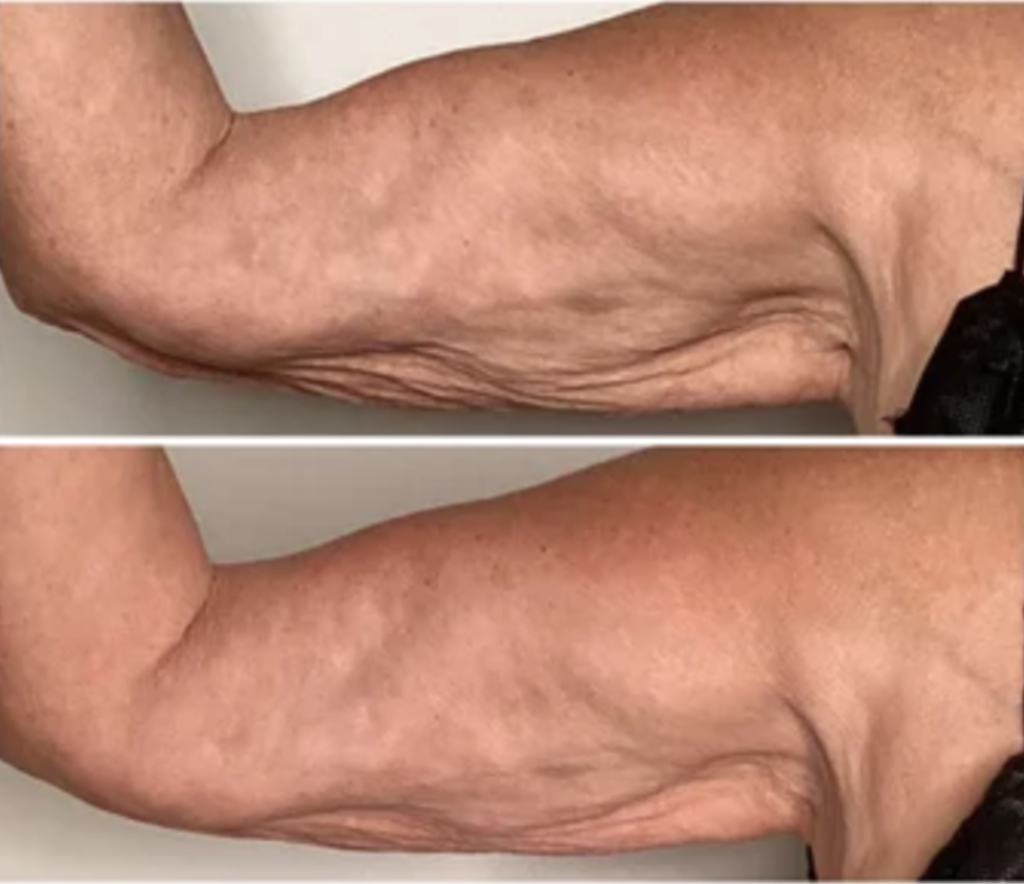 Onda (4) Onda arm skin tightening