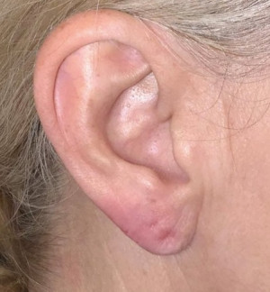 Ear Lobe Filler