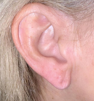Ear Lobe Filler